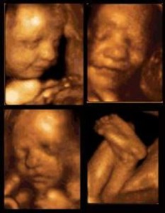 Segundo o STF, é permitido matar um nascituro até seus 3 meses [foto acima e abaixo]. Como fica a Lei de Deus: “Não matar”? 