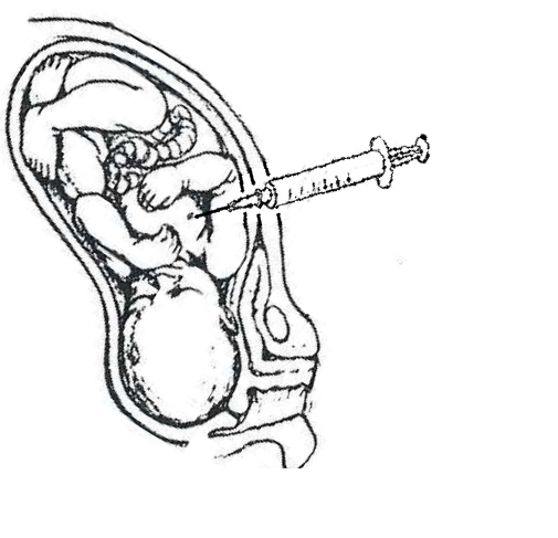 O parecer pró-vida de Gonet